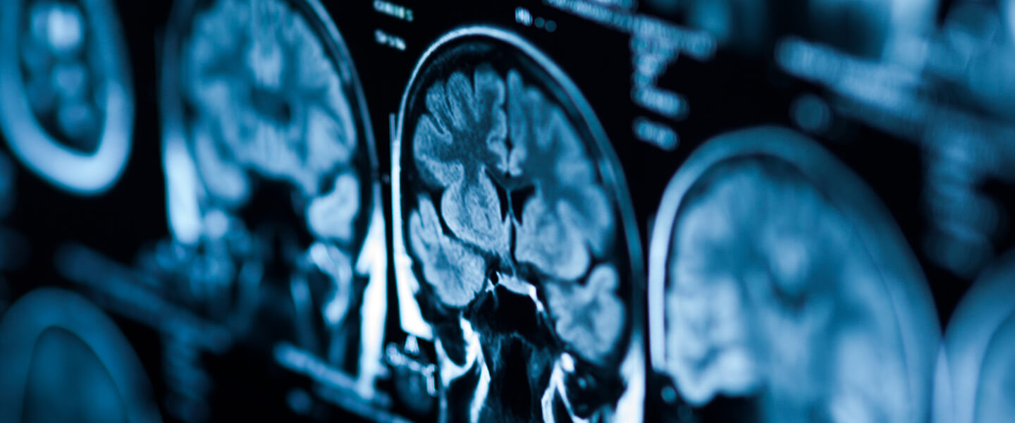 Possible Neural Signatures of Future Depression &amp; Anxiety Onset in High-Risk Adolescents’ Resting-State Brain Scans
