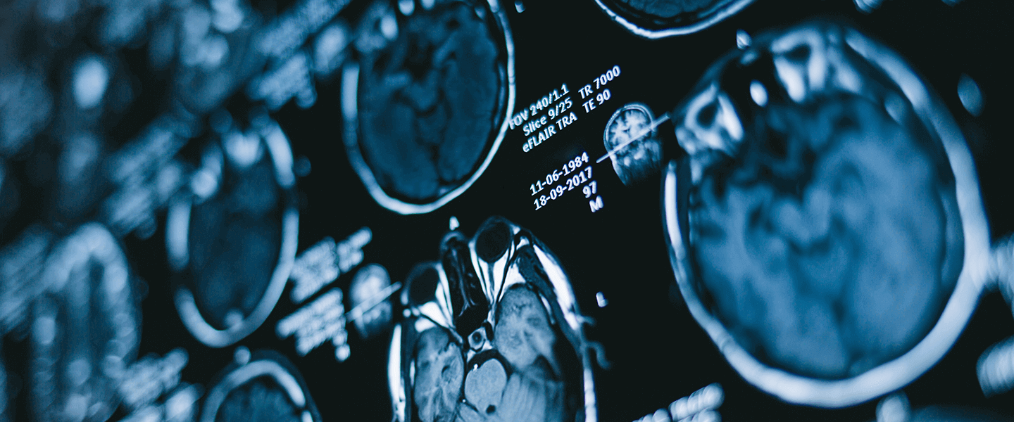 Interpretation of Brain Scan Results Suggests Ways of Optimizing Psychotherapies for OCD
