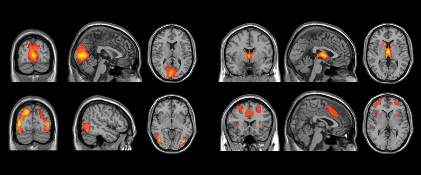 Brain aging in major depressive disorder: results from the ENIGMA