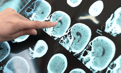 Deep-Brain Stimulation Gided by Brain Mapping Resulted in Rapid & Acute Reduction in Severe OCD Symptoms in Trial Patient