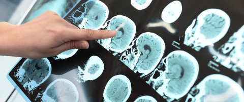 Testing a New Way to Precisely Target and Predict the Impact of TMS Brain Stimulation for Depression