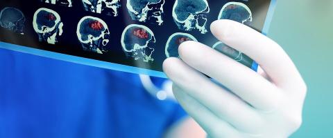 Brain Scans Reveal a Possible Biomarker for Suicidal Thoughts in PTSD Brain Scans Reveal a Possible Biomarker for Suicidal Thoughts in PTSD